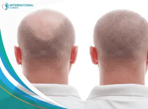 hair transplant surgery Plastic Surgery in Turkey,Cosmetic surgery in Turkey