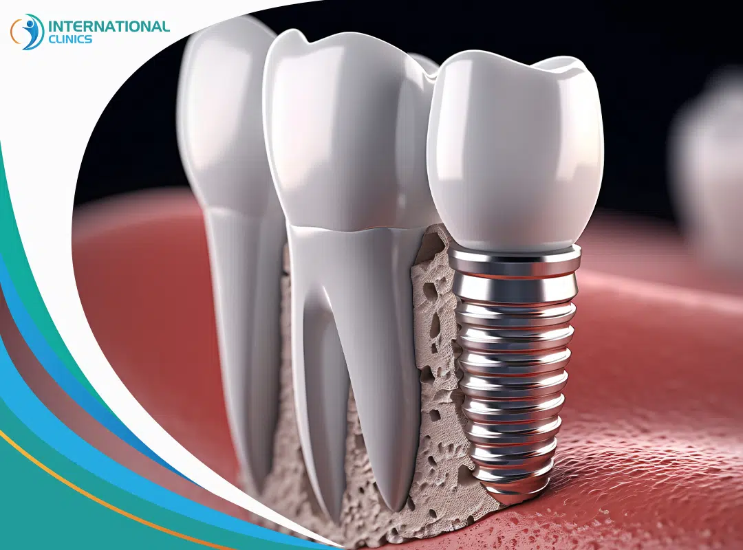 cda8f75227d20f84405b99095d43eb49 Dental Implants Cost in Turkey